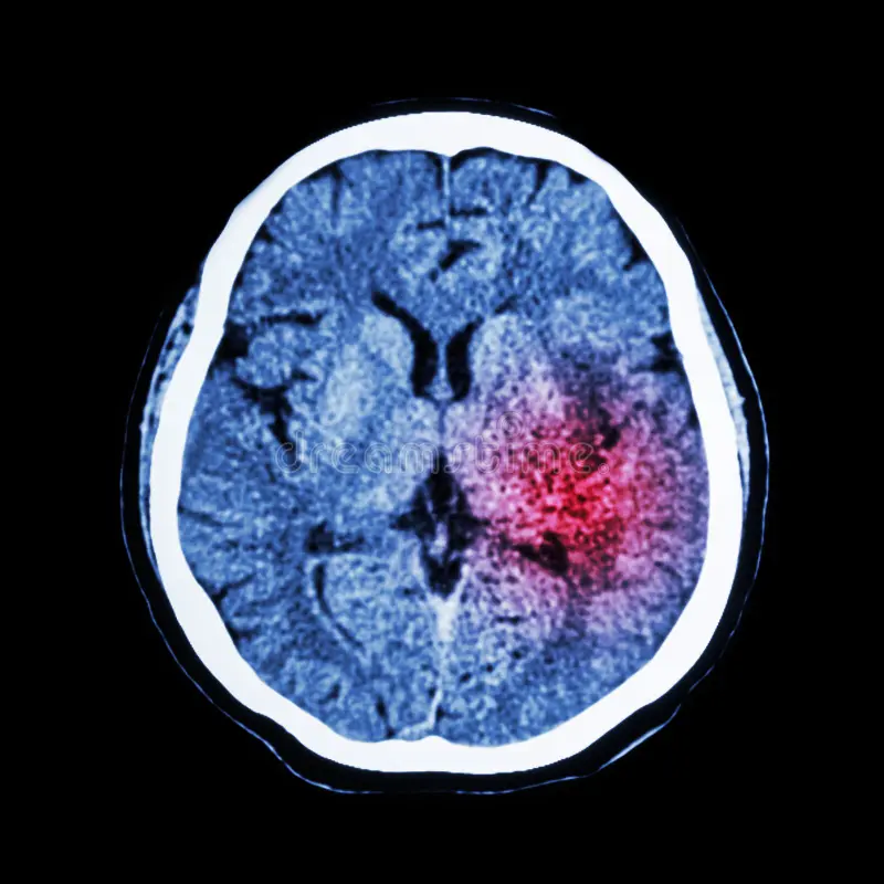 Stroke Screening